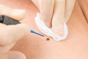 Szakmai nap összefoglaló: A rosszindulatú bőrgyógyászati elváltozások differenciáldiagnosztikája